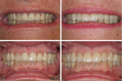 veneers-008