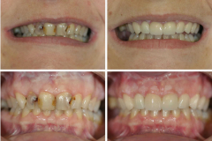 veneers-018